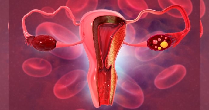 Investigadores sostienen que los resultados de esta investigación sostienen que son de beneficio para los pacientes con cáncer de ovario.